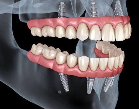 WHAT IS A PERIODONTIST?