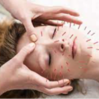 Cosmetic Acupuncture Session